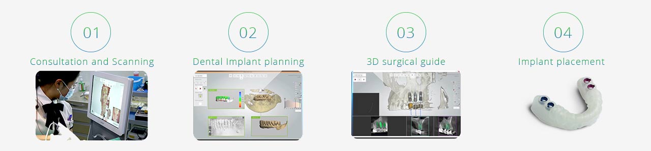 digital dental implant procedure in sydney